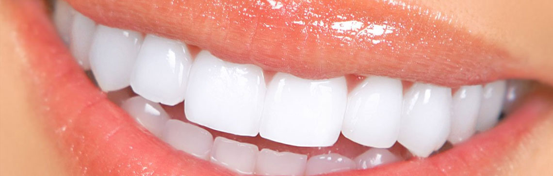 closeup of veneers