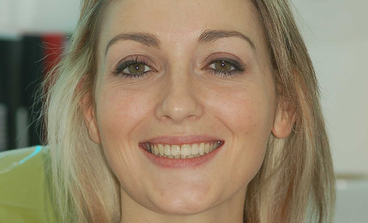 after invisalign treatment in West Bridgford