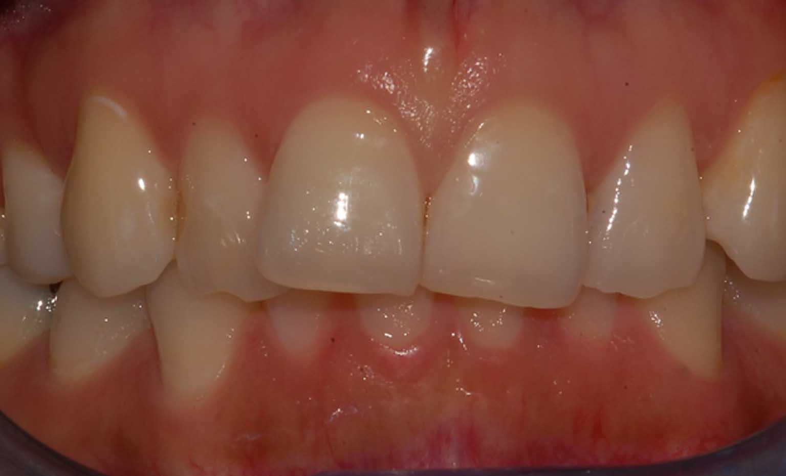 Before smile treatment at Bridgford Dental Practice