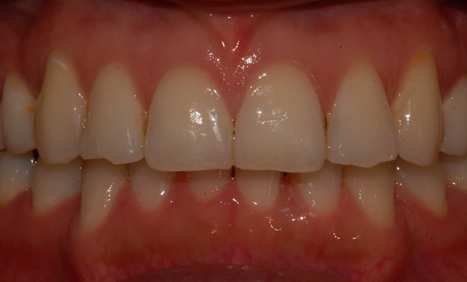 after teeth straightening treatment at Bridgford Dental Practice