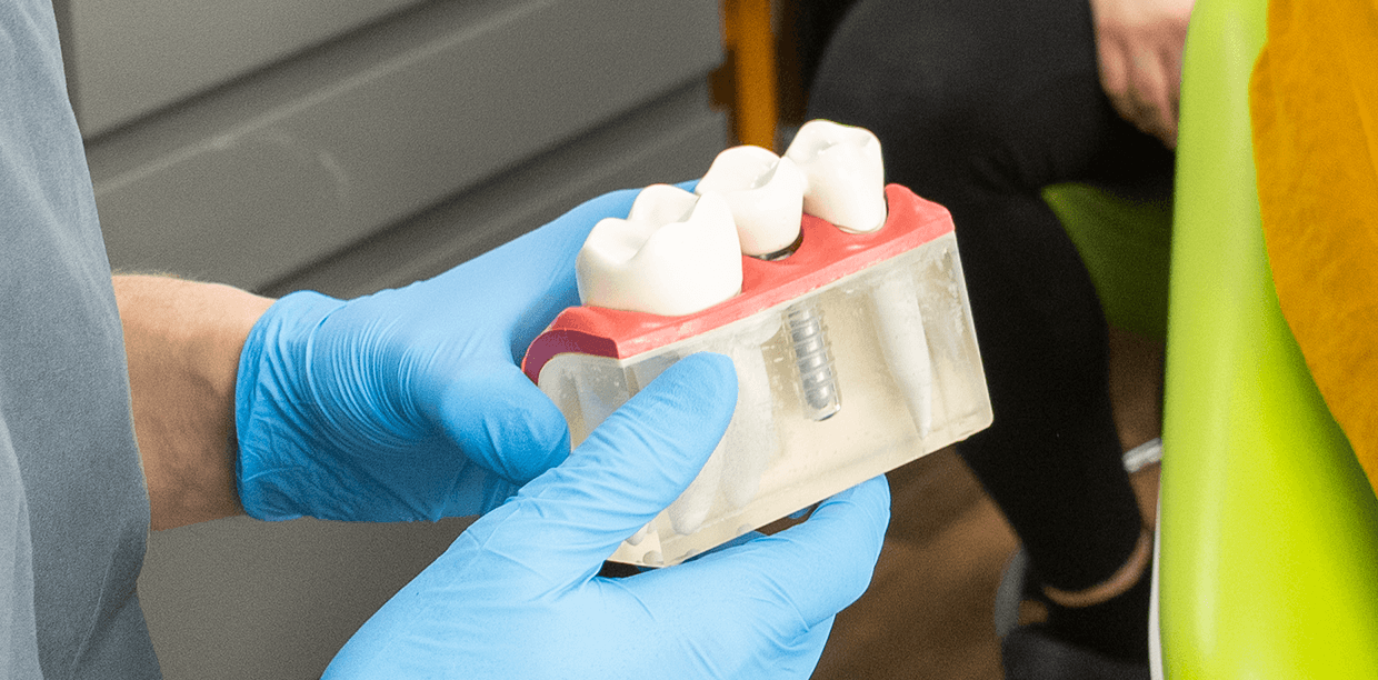 a mould showing dental implants for bridgford dental