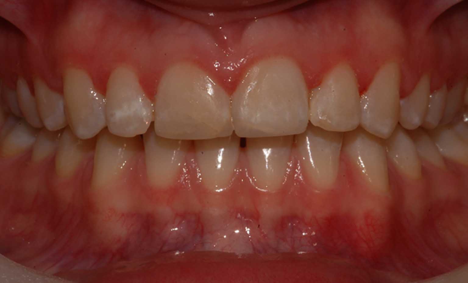 after smile treatment at Bridgford Dental Practice