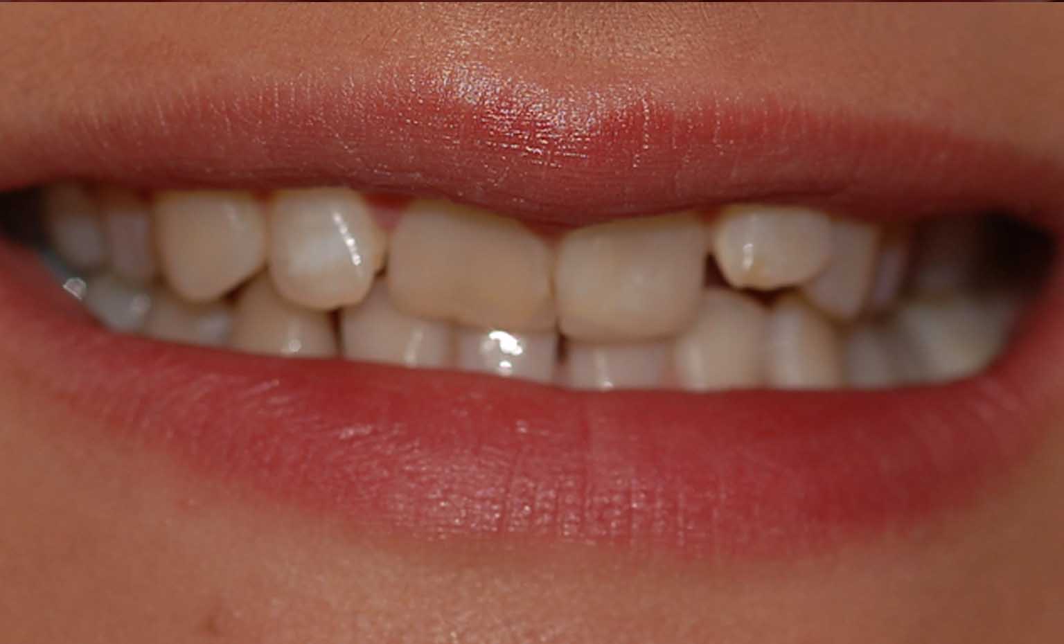 Before smile treatment at Bridgford Dental Practice