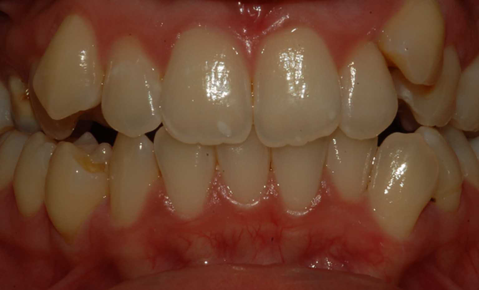 before teeth straightening at Bridgford Dental Practice