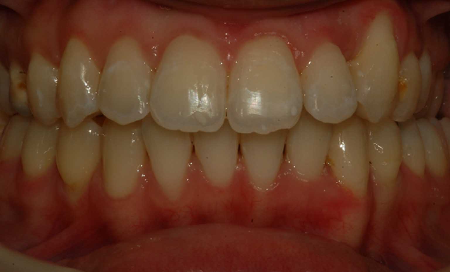 after an invisalign treatment at Bridgford Dental Care