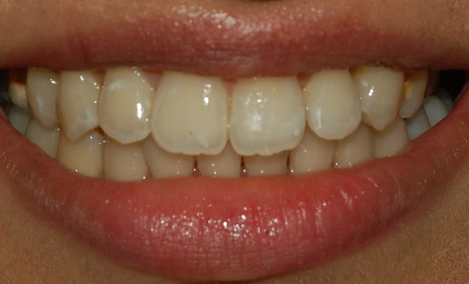 after smile treatment at Bridgford Dental Practice