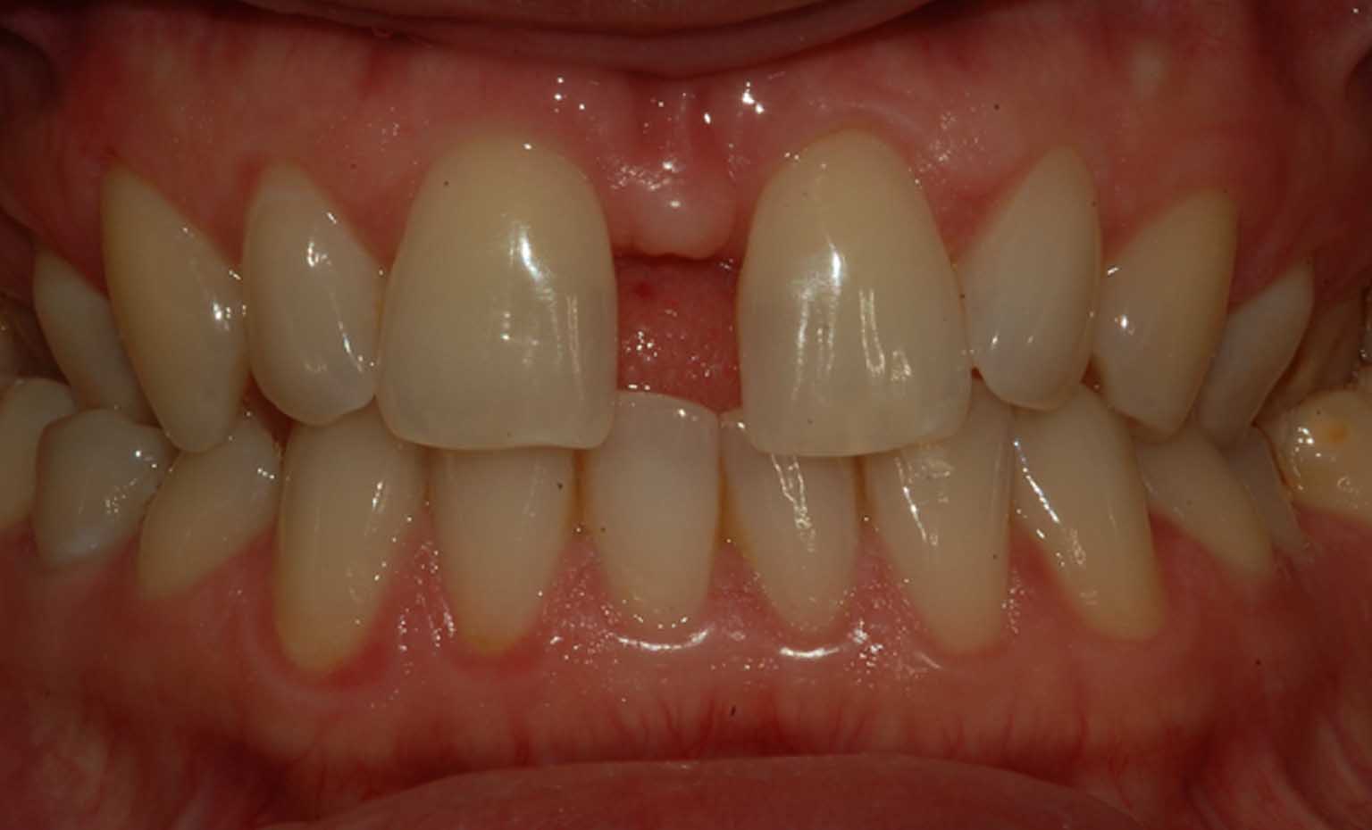 Before tooth gap treatment at Bridgford Dental Practice