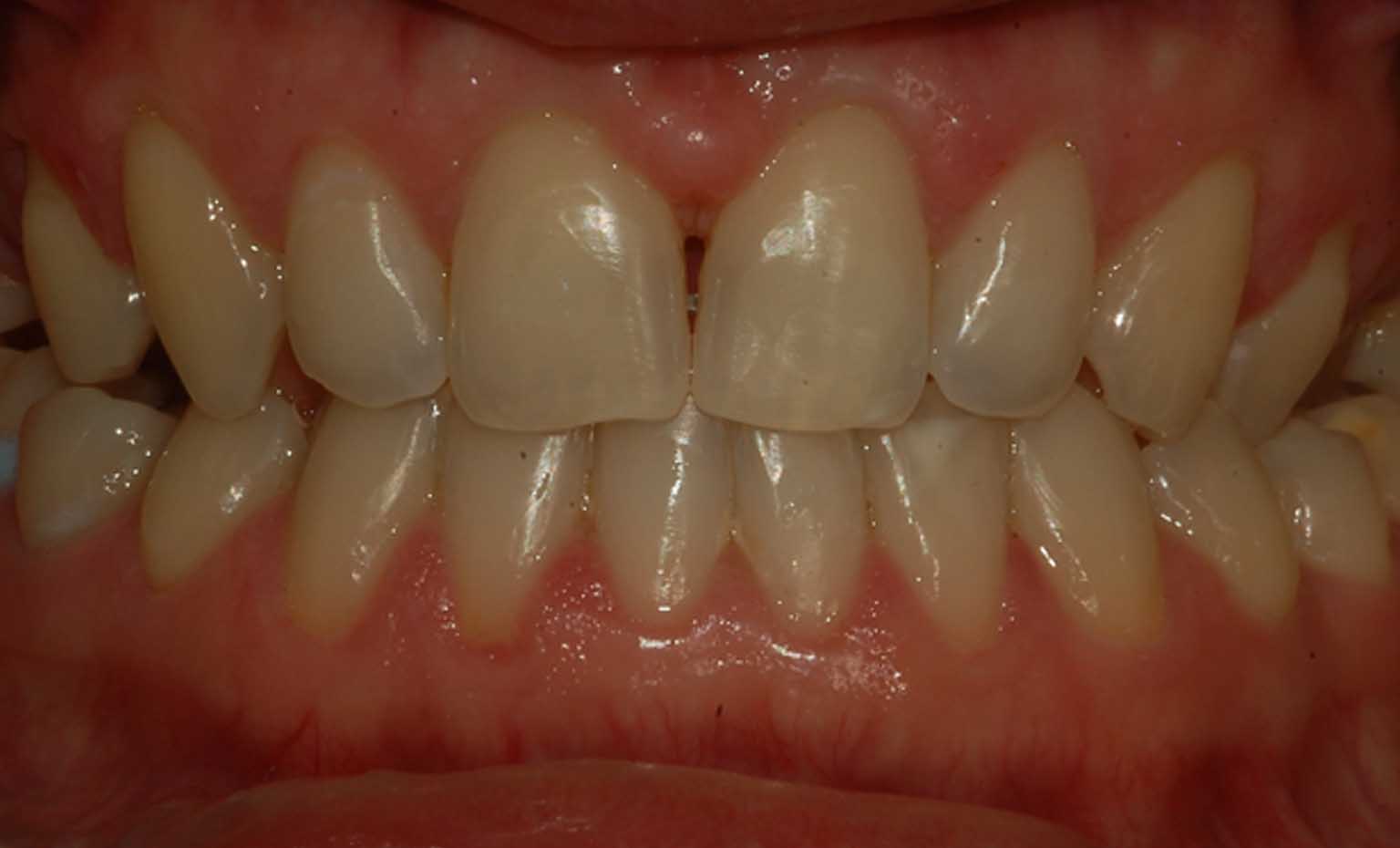 after tooth gap treatment at Bridgford Dental Practice