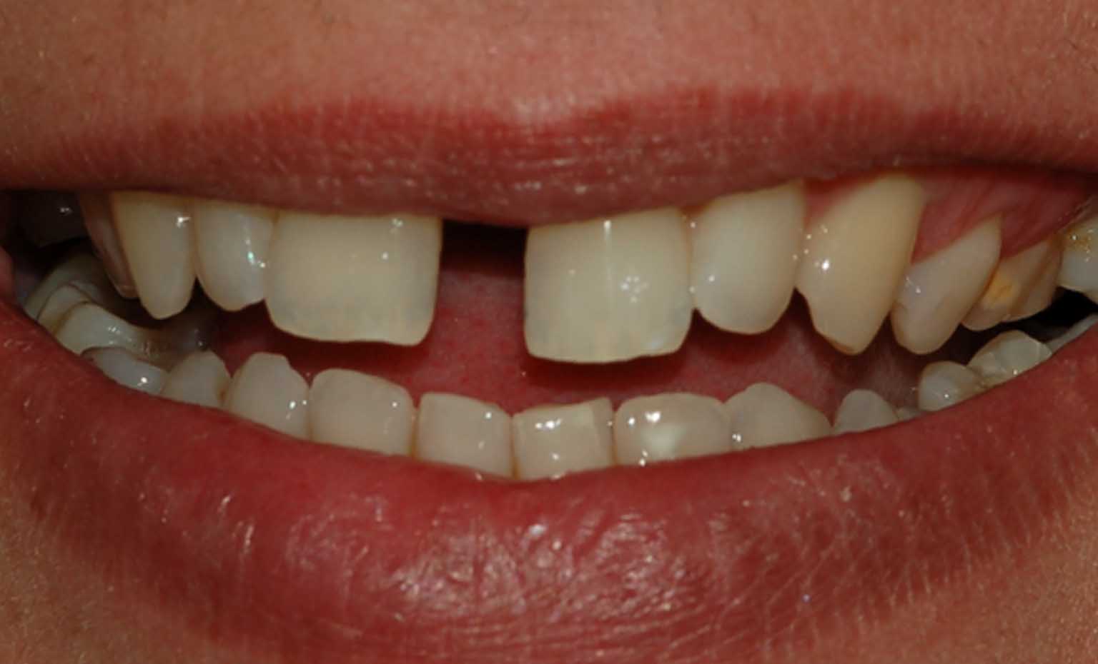 before smile makeover treatment at bridgford dental