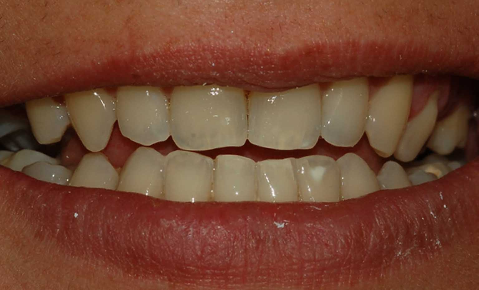 After smile treatment at Bridgford Dental Practice