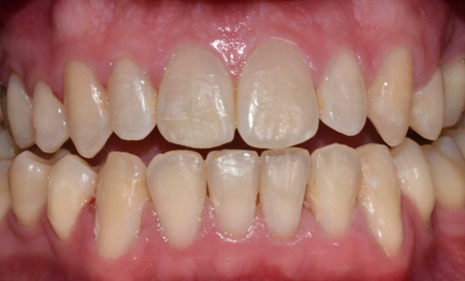 After smile treatment at Bridgford Dental Practice