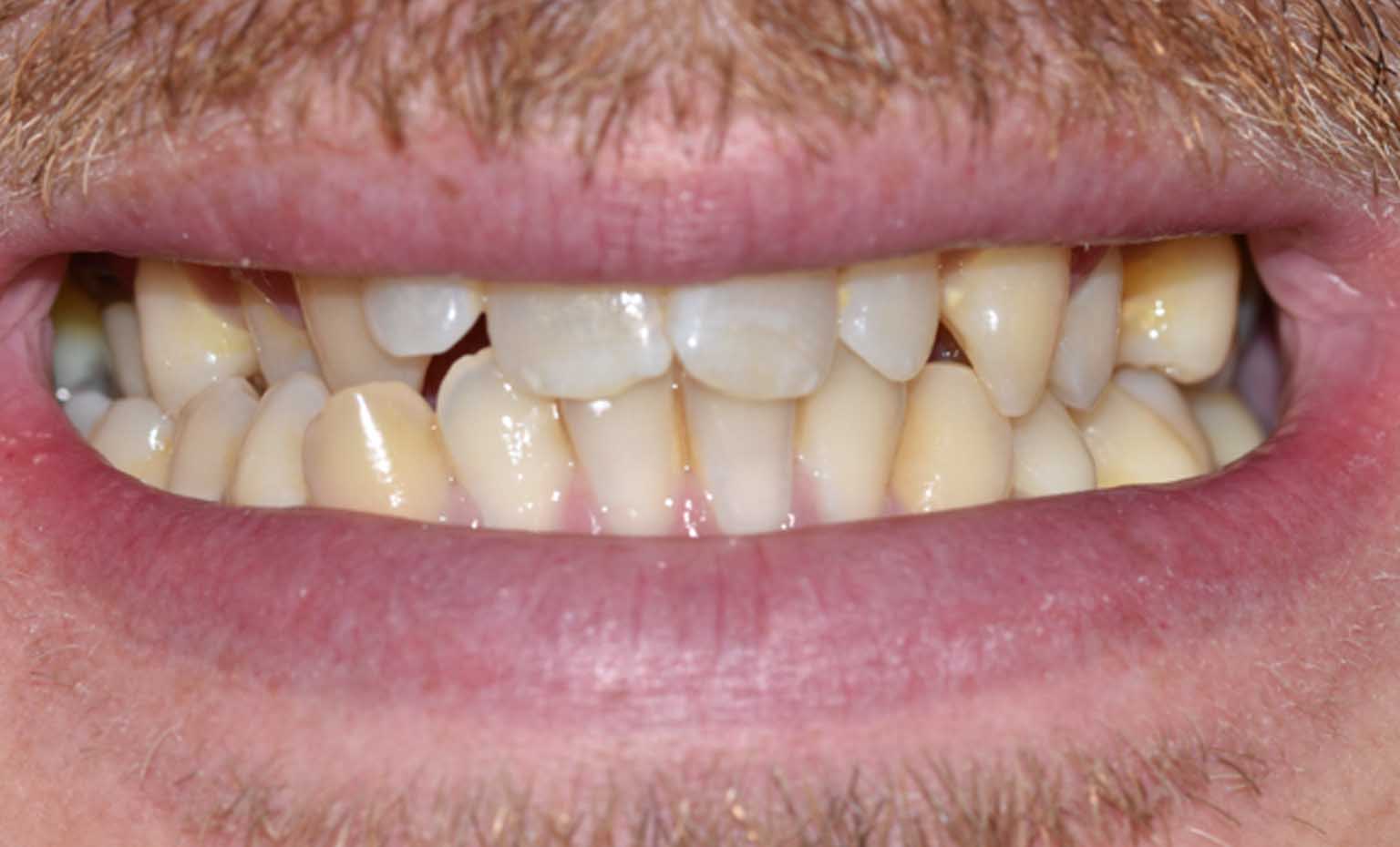 Before smile treatment at Bridgford Dental Practice