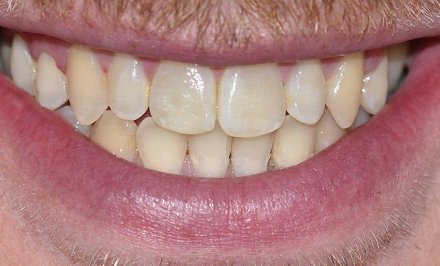 after teeth straightening treatment at Bridgford Dental Practice