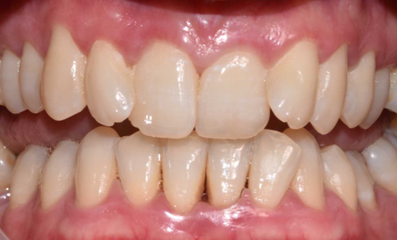 Before smile treatment at Bridgford Dental Practice