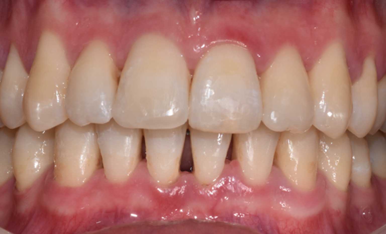 after smile treatment at Bridgford Dental Practice