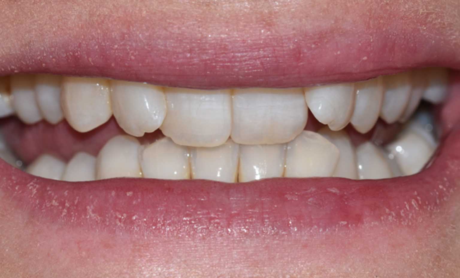 Before smile treatment at Bridgford Dental Practice