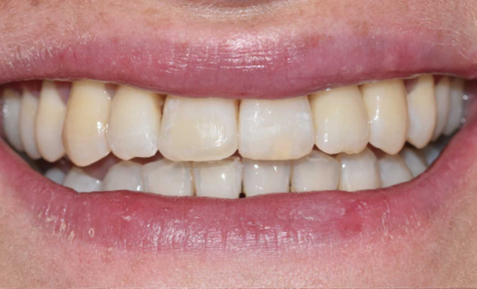 After teeth straightening treatment at Bridgford Dental Practice