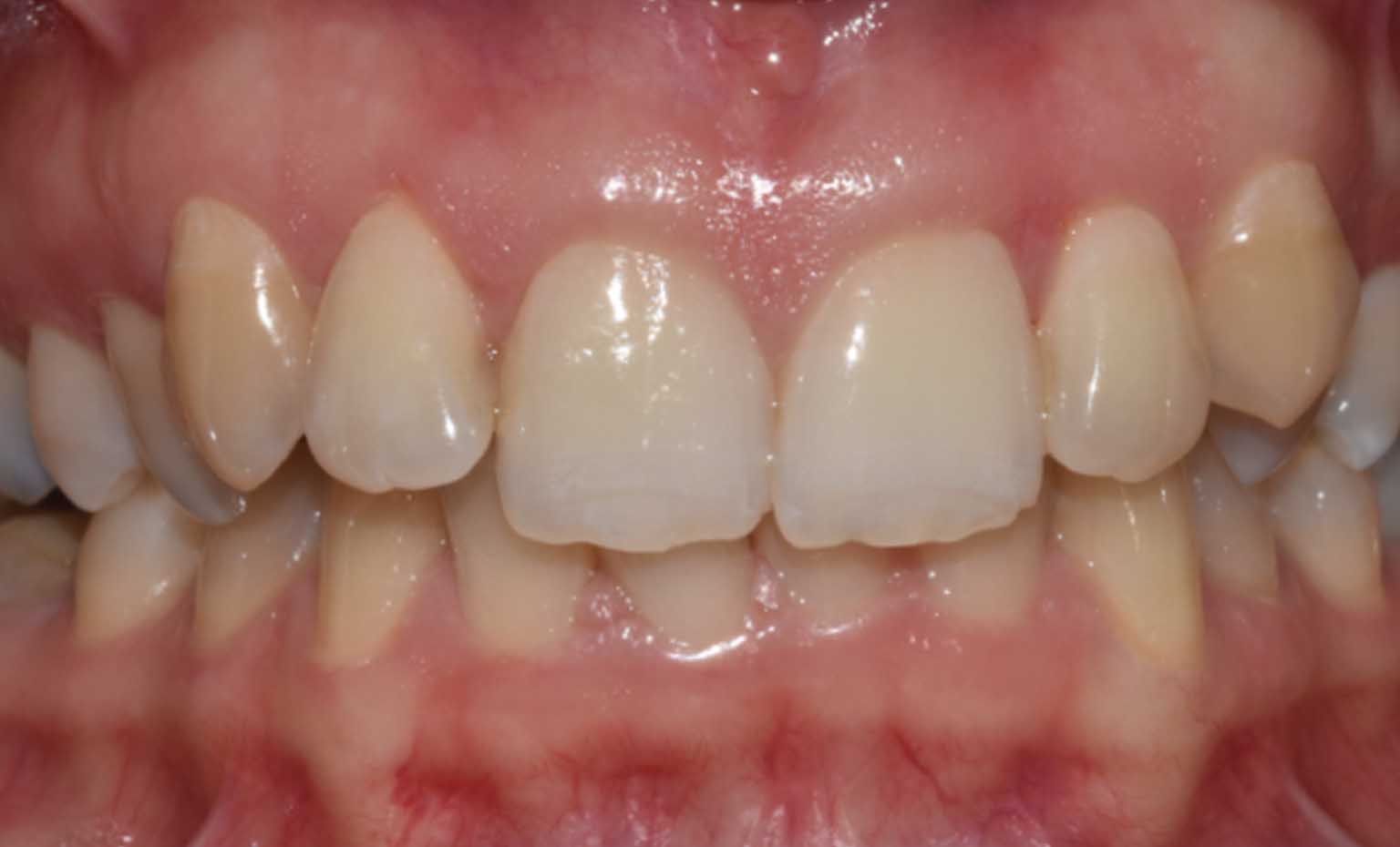 Before smile treatment at Bridgford Dental Practice