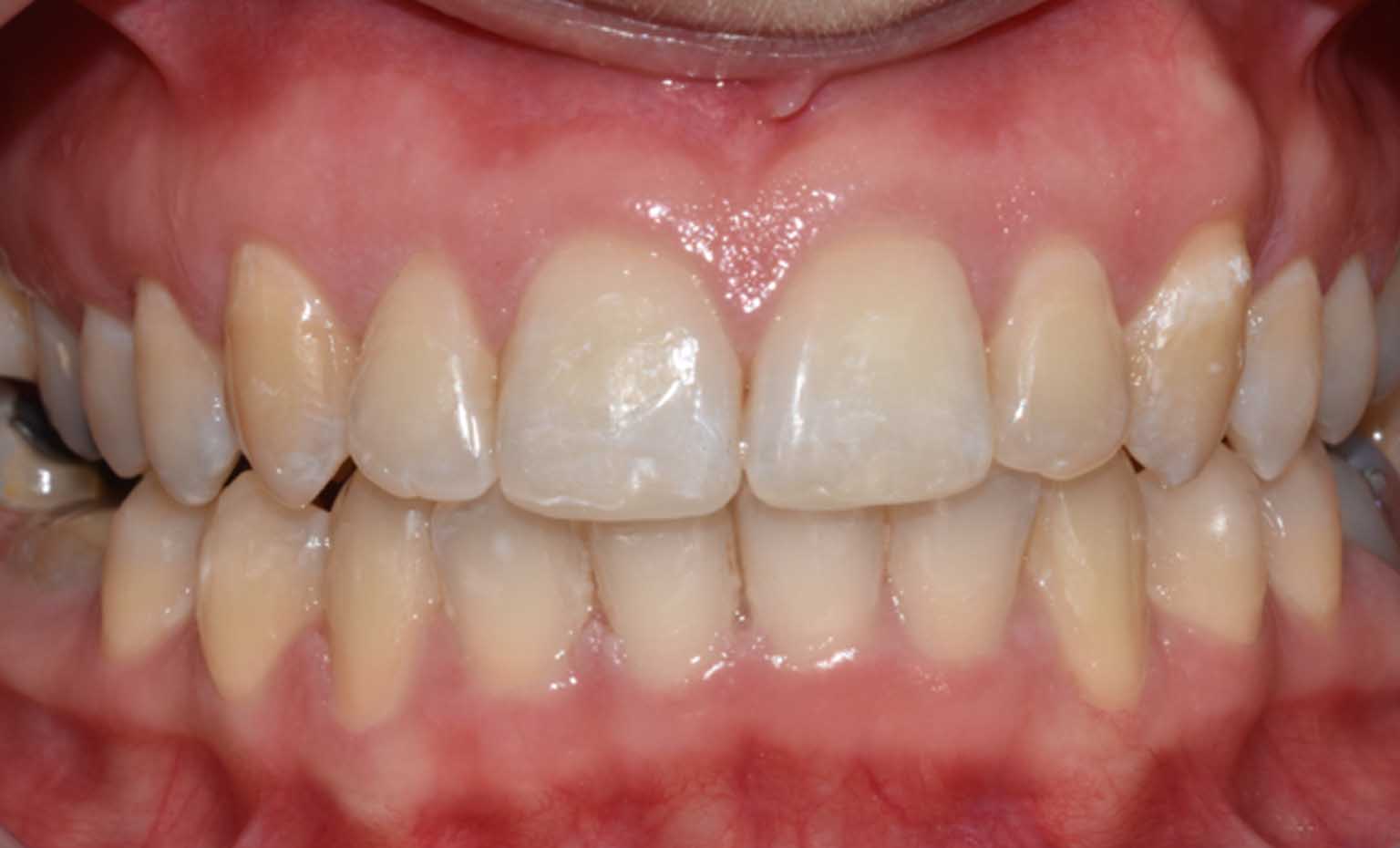 After teeth whitening treatment at Bridgford Dental Practice