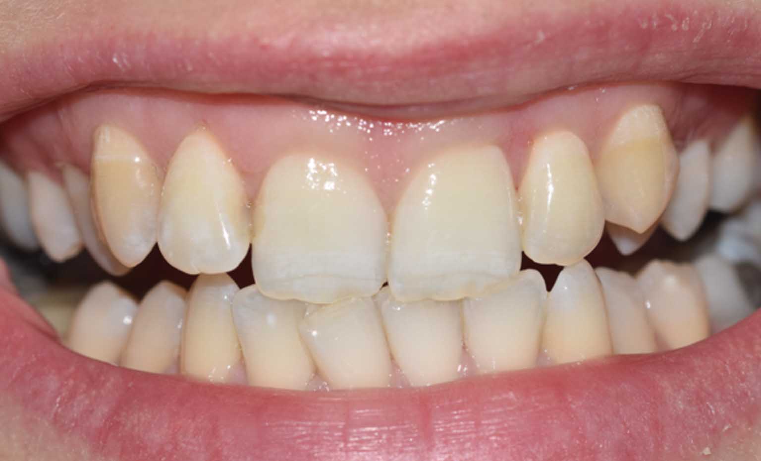 before teeth straightening treatment at Bridgford Dental Care