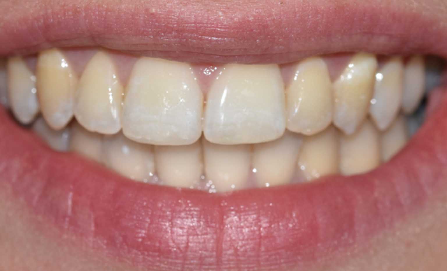 After smile makeover treatment at Bridgford Dental