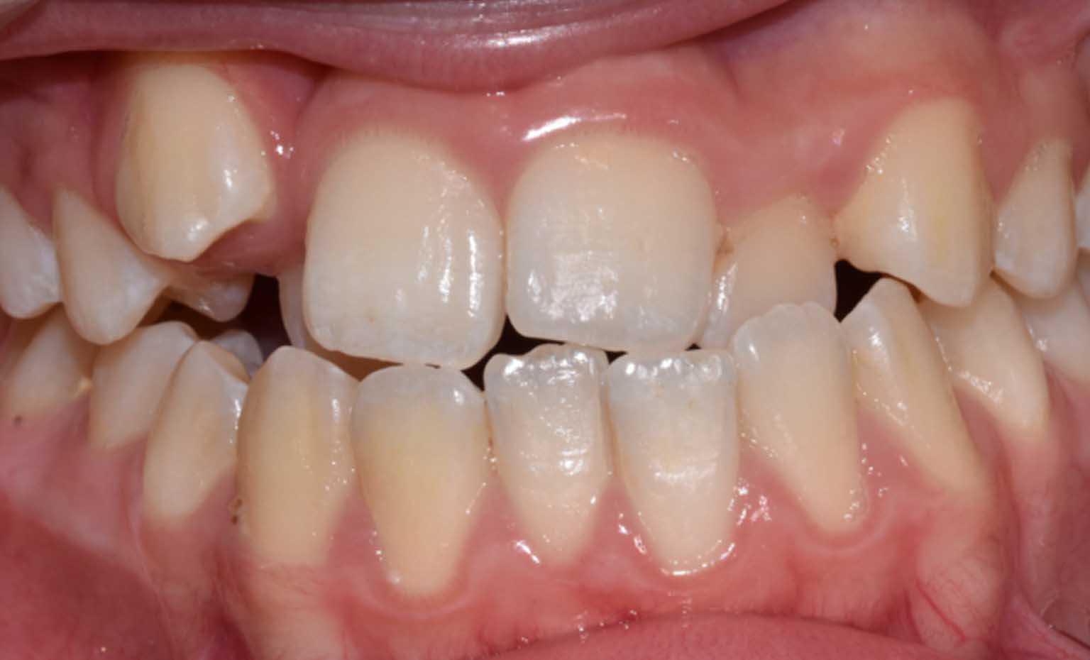 Before smile treatment at Bridgford Dental Practice