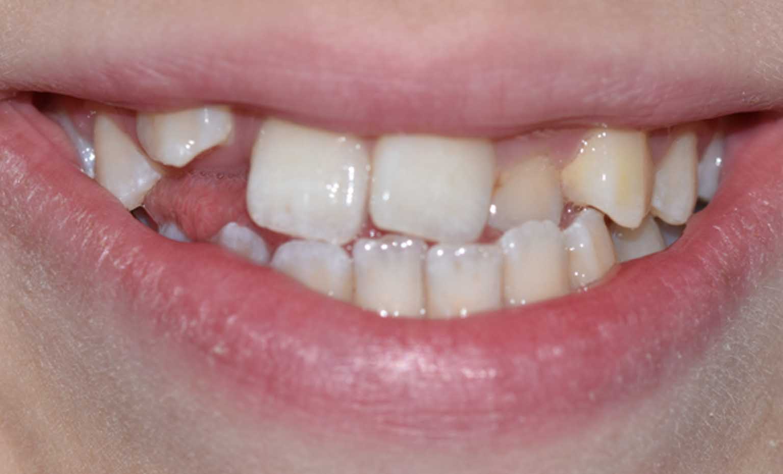 Before smile treatment at Bridgford Dental Practice
