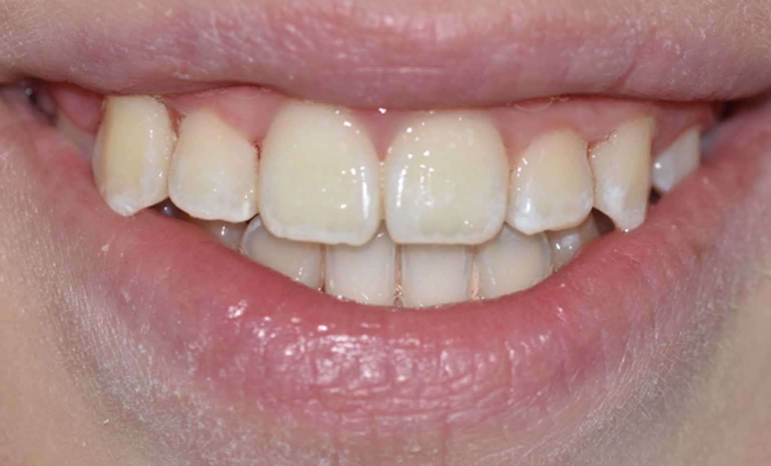 After teeth straightening at Bridgford Dental Practice