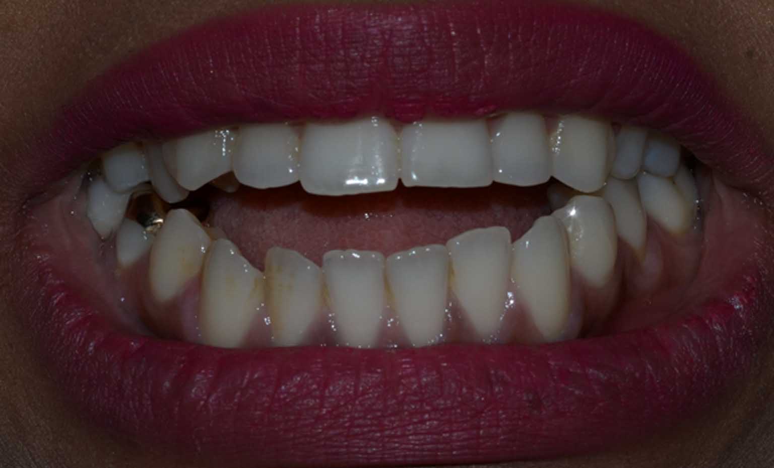 before teeth straightening treatments in Nottingham