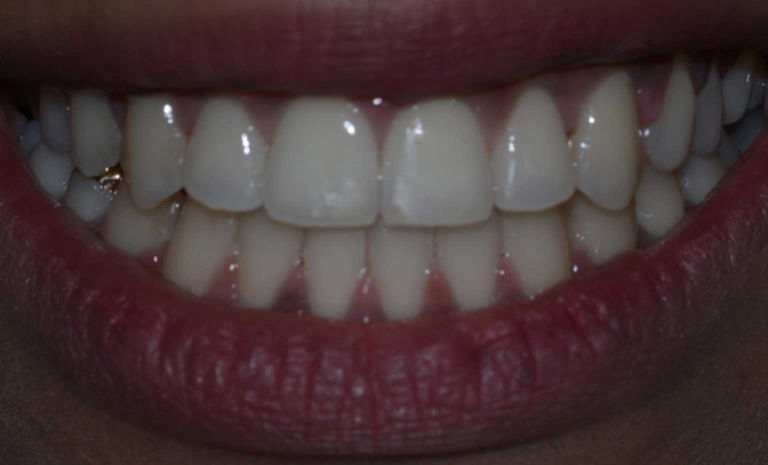 after teeth whitening treatments from Bridgford Dental Practice in Nottingham