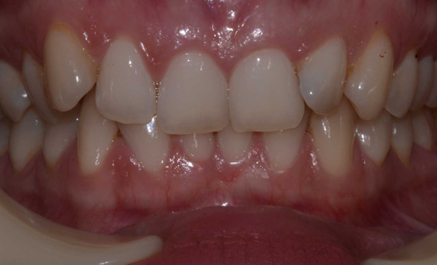 before teeth straightening treatment in nottingham