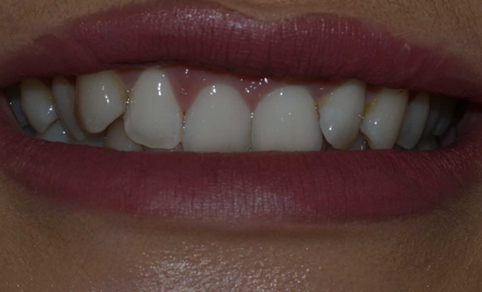 before teeth straightening in West Bridgford