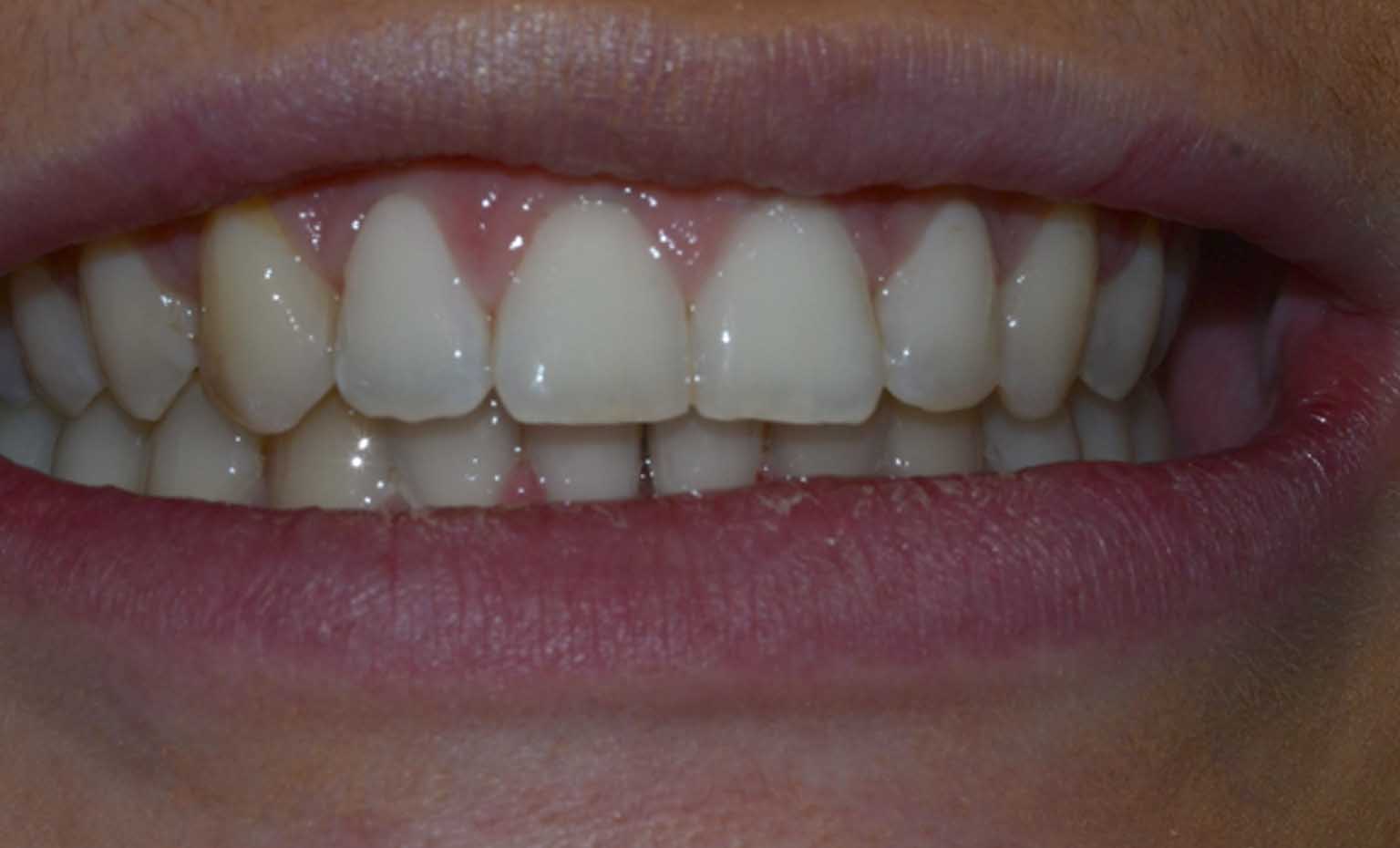 after teeth whitening treatment in Nottingham