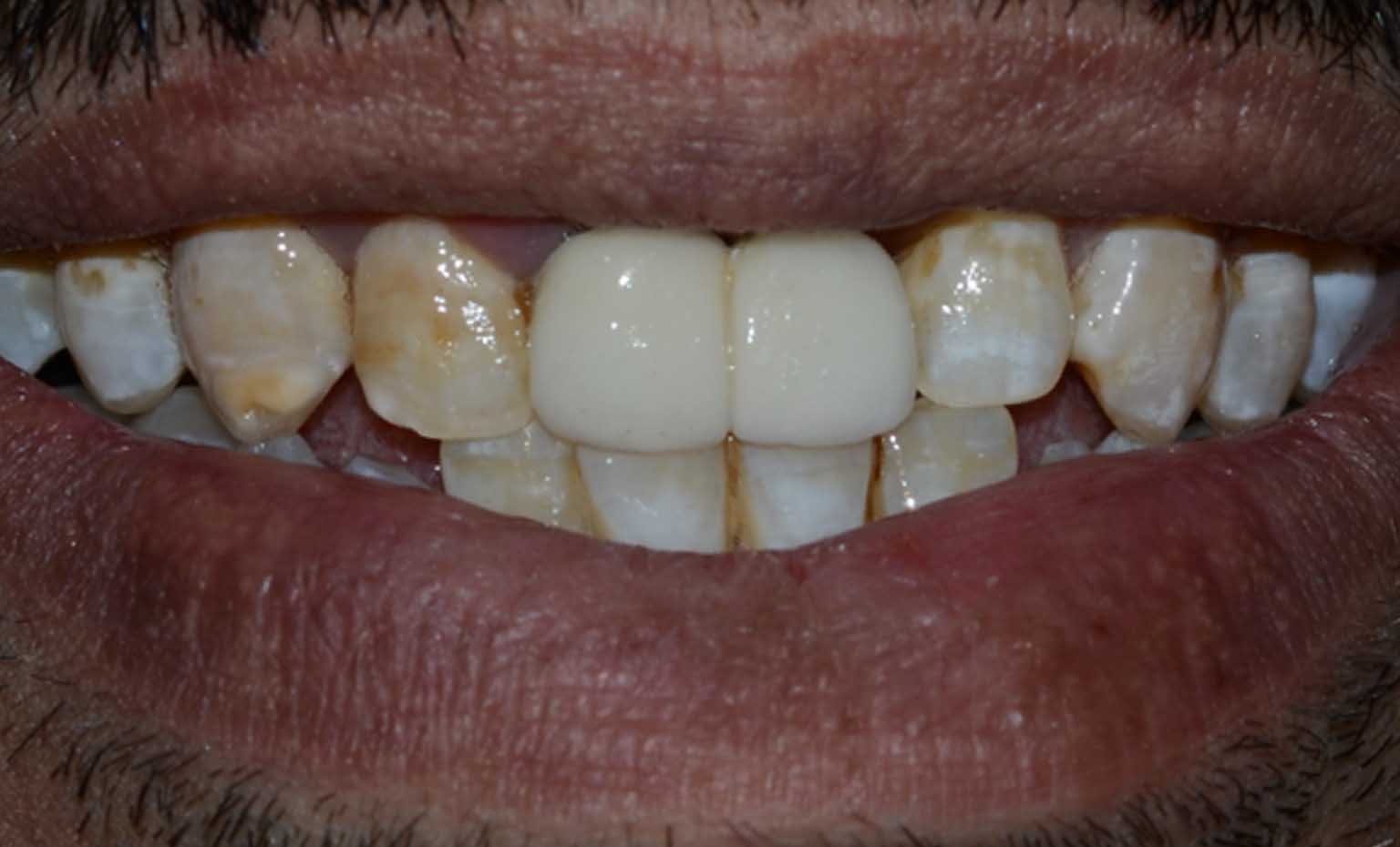 before teeth straightening treatment in West Bridgford