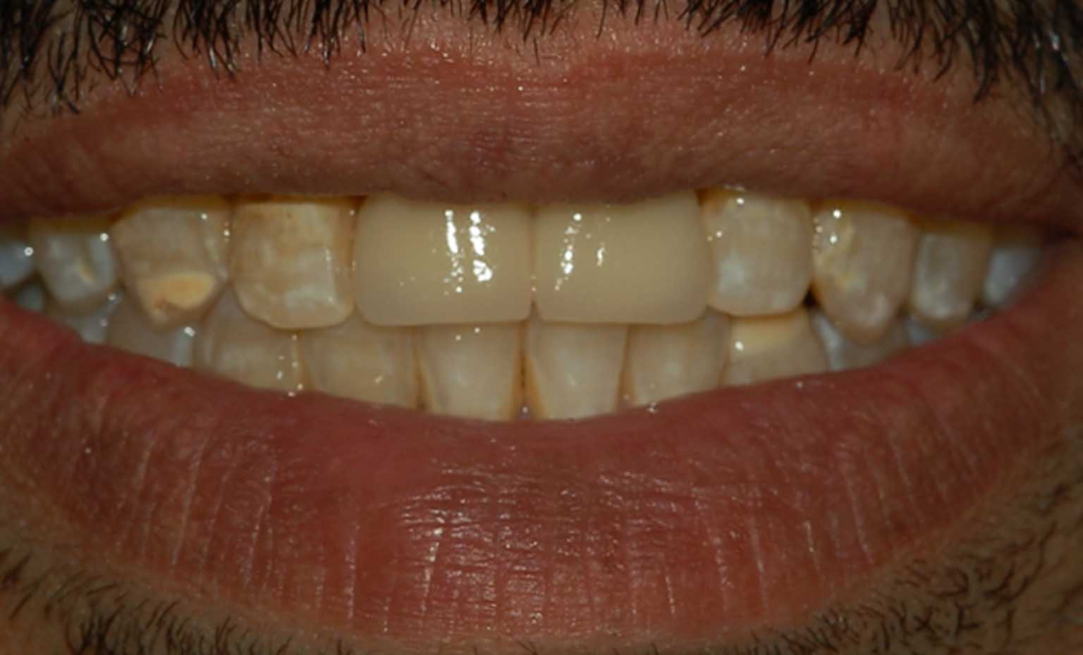 after teeth straightening treatment in West Bridgford