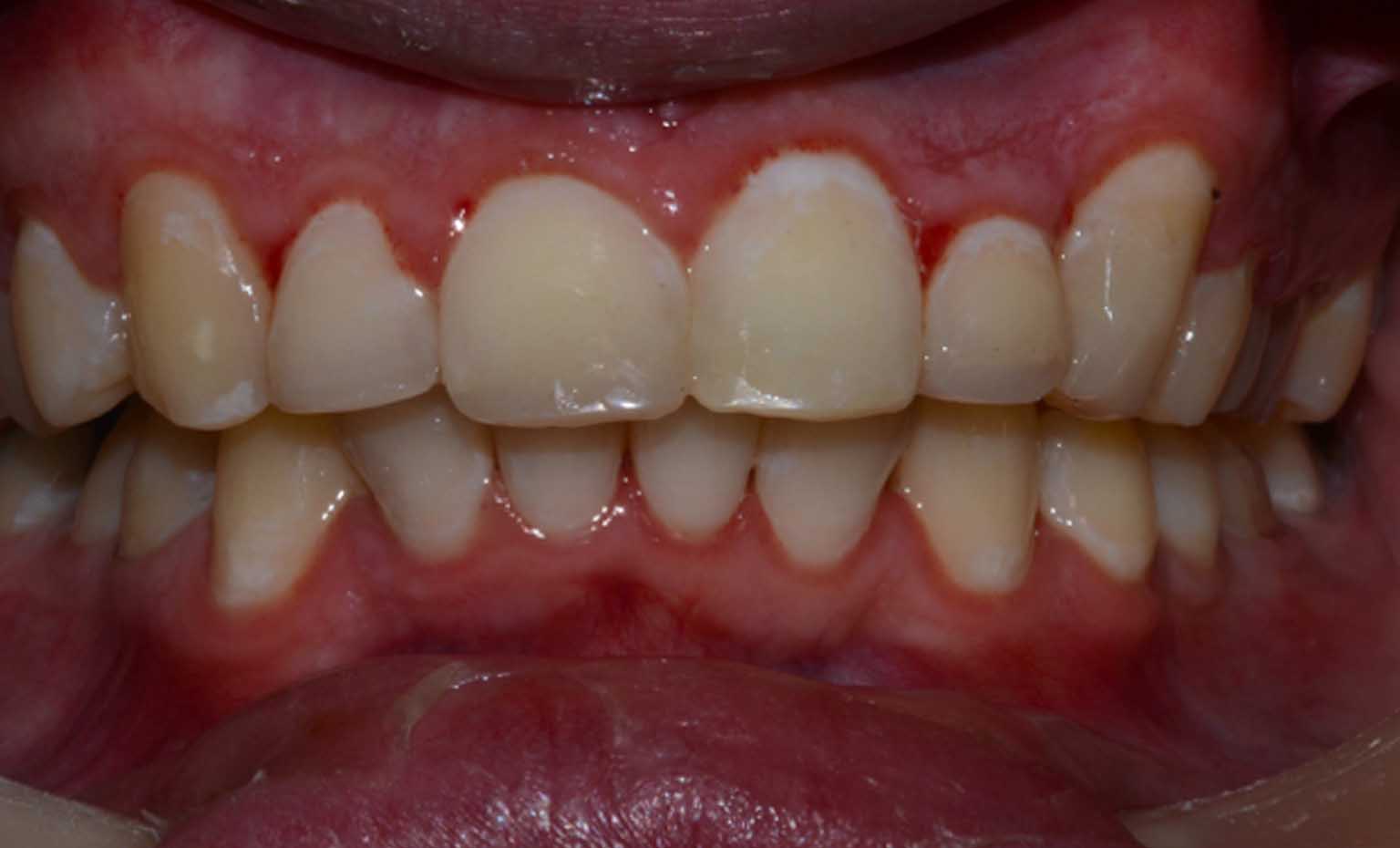after teeth transformation in Nottingham