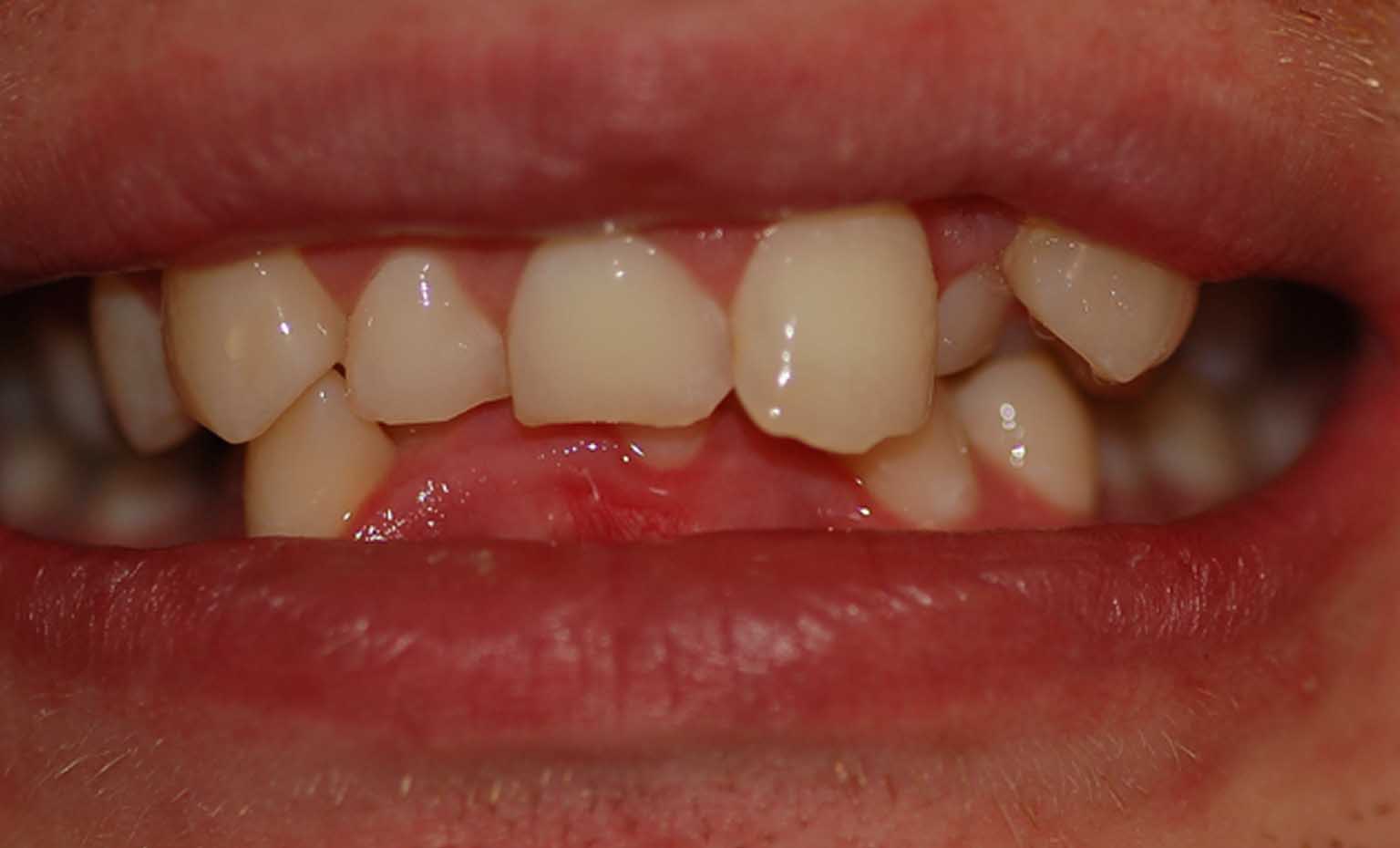 before teeth transformation in Nottingham