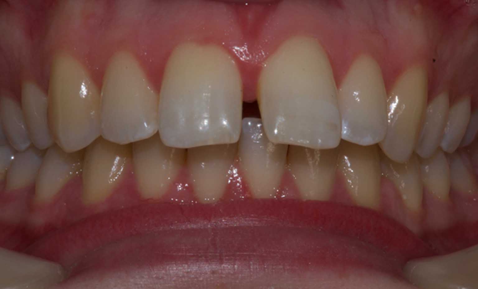 before teeth straightening treatment in West Bridgford