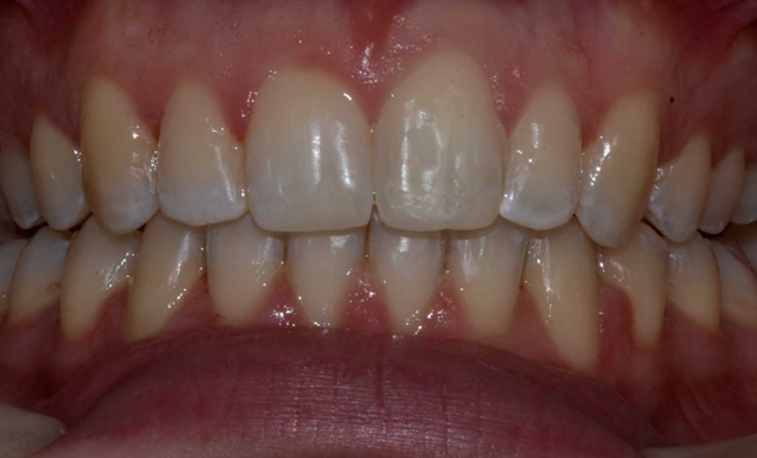 after teeth straightening treatment in West Bridgford