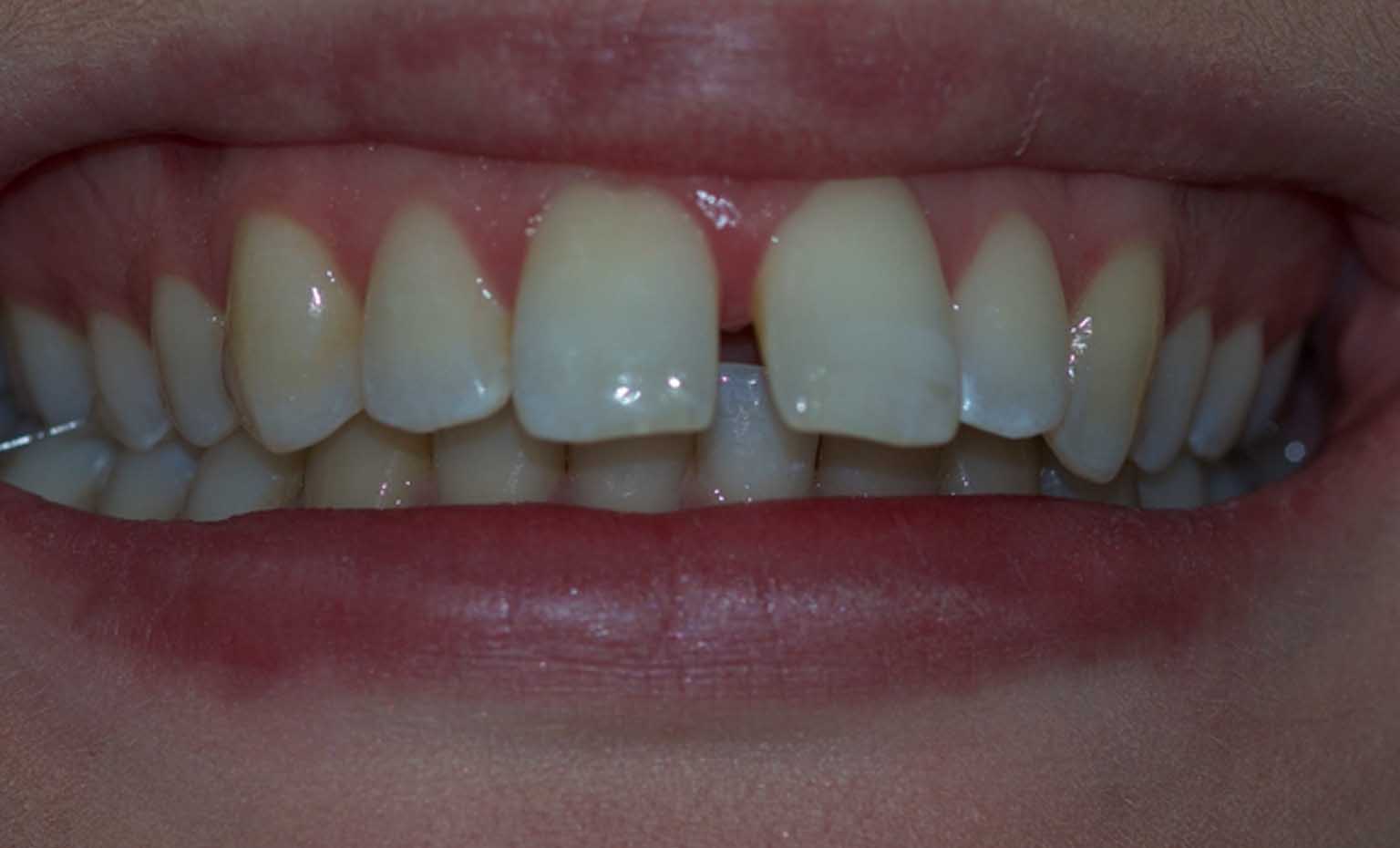 before teeth straightening treatment in West Bridgford