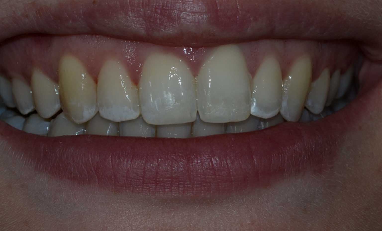 after teeth straightening treatment in West Bridgford