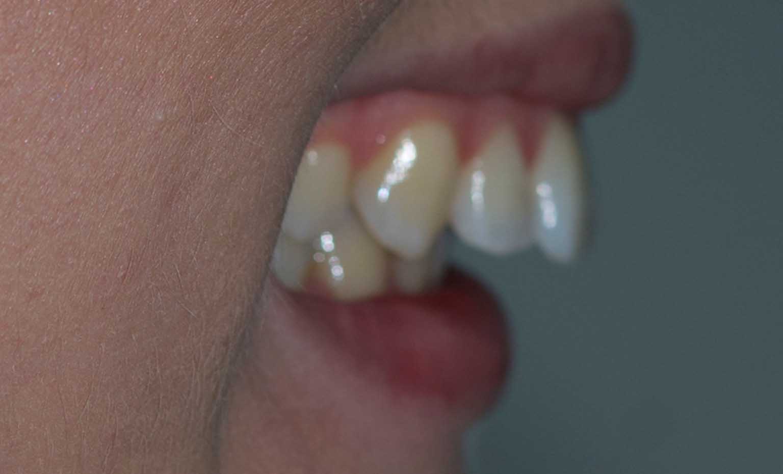 before overbite treatment at West Bridgford Dental Practice