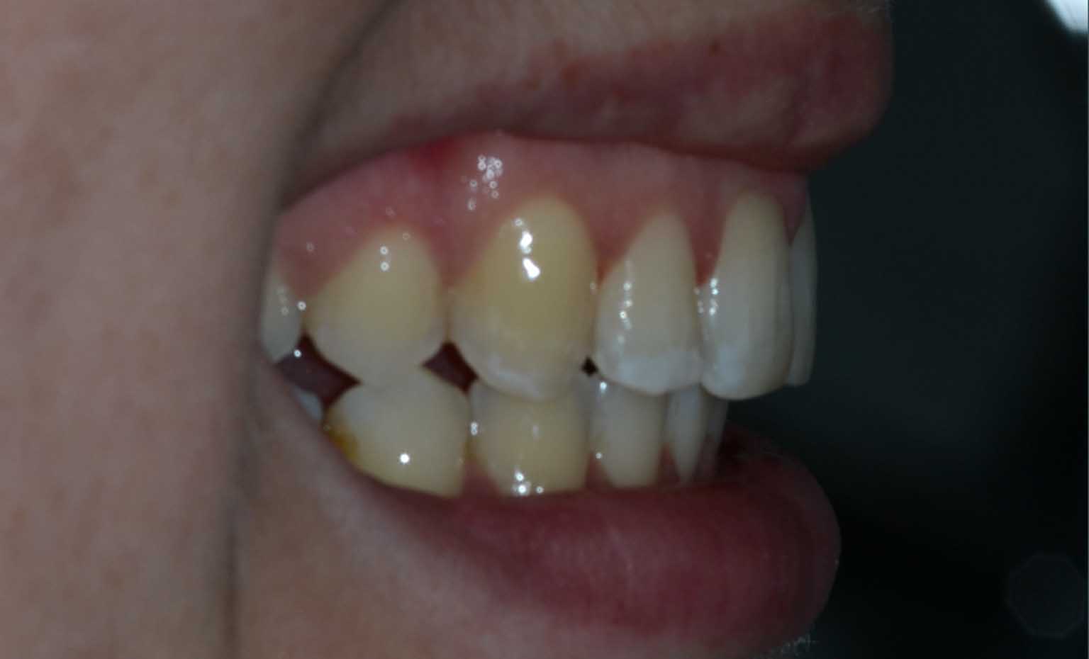 overbite treatment at West Bridgford Dental Practice