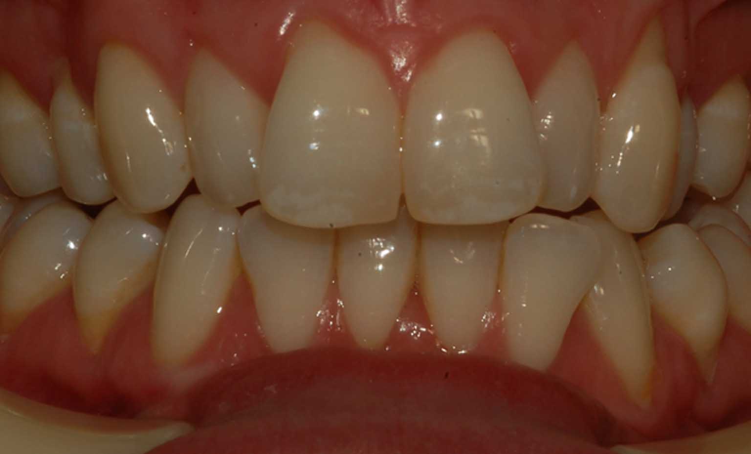 before photos of teeth straightening and whitening treatment