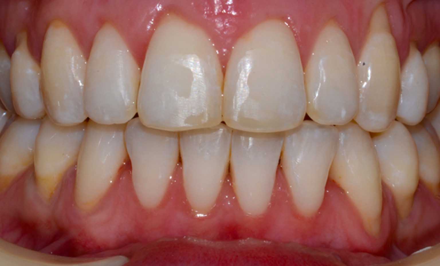 after photos of teeth straightening and whitening treatment