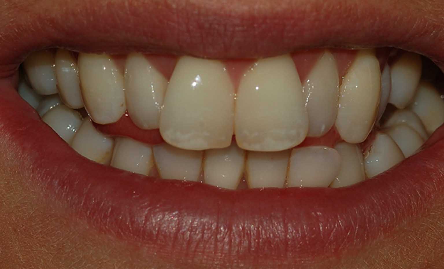 before photos of teeth straightening and whitening treatment