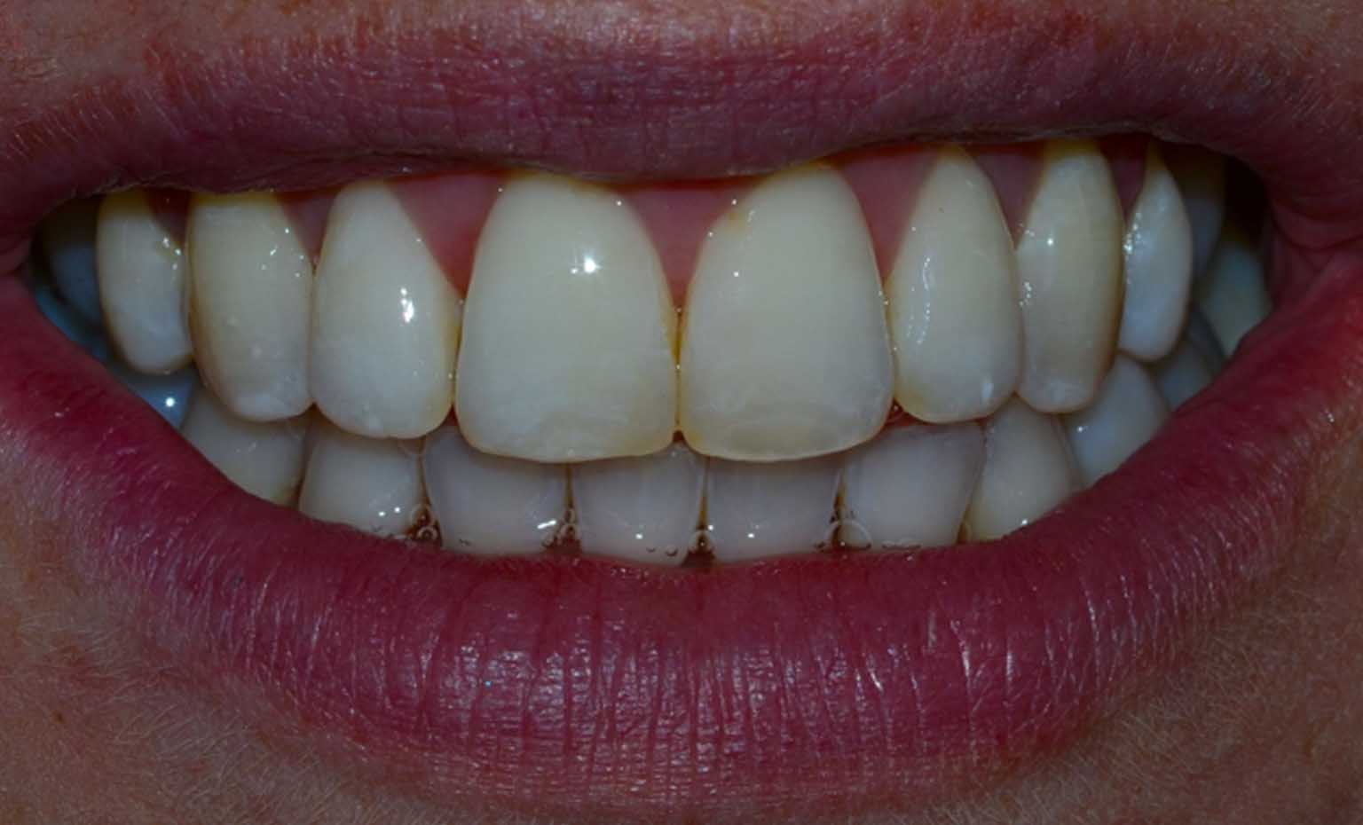 after photos of teeth straightening and whitening treatment