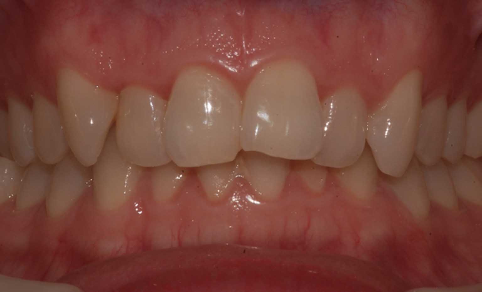 before photos of dental treatment from West Bridgford practice