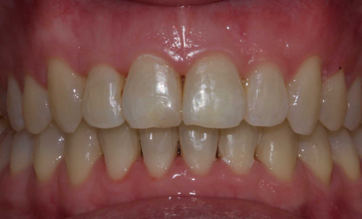 after photos of dental treatment from West Bridgford practice