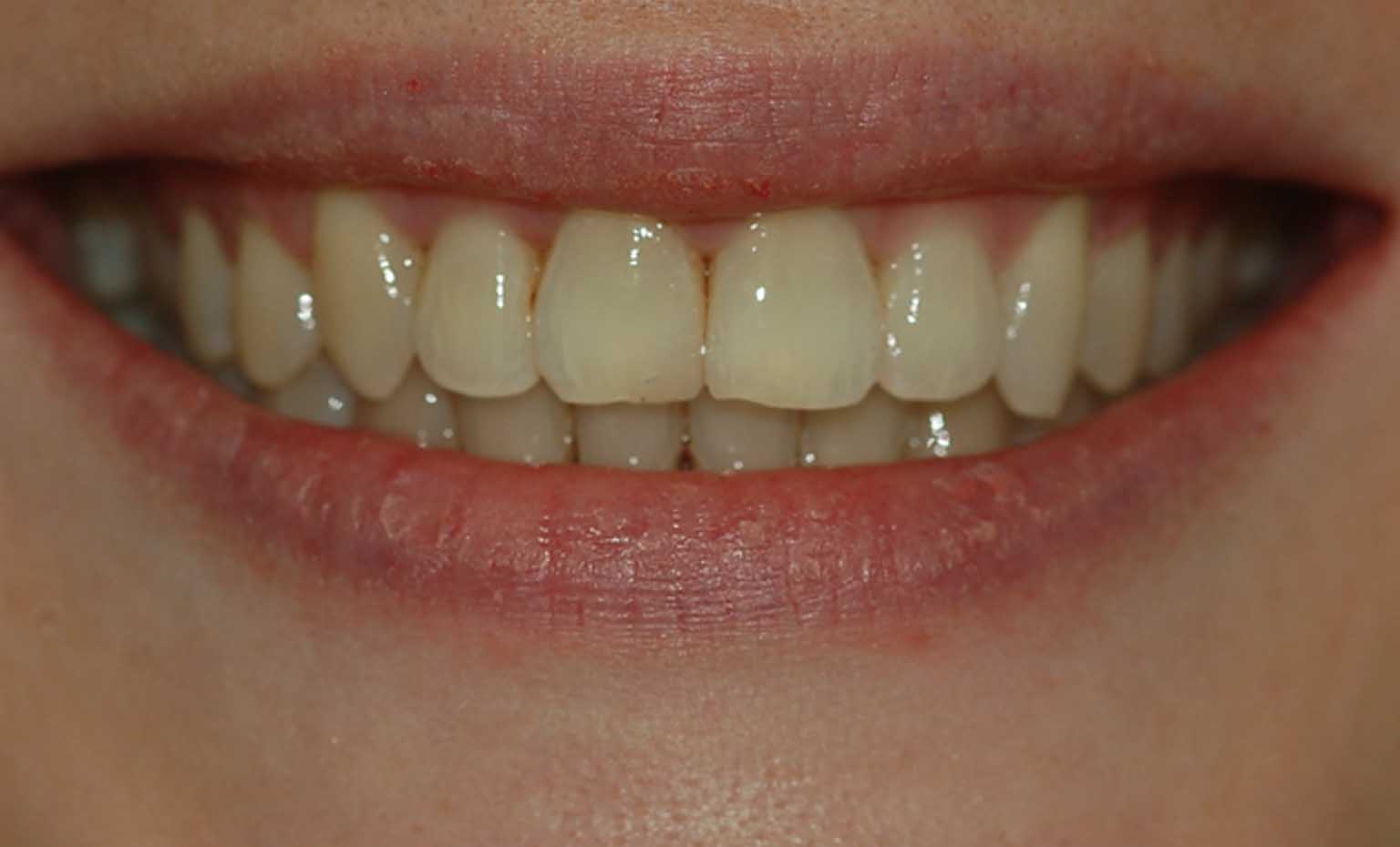 after invisalign treatment in west bridgford nottingham